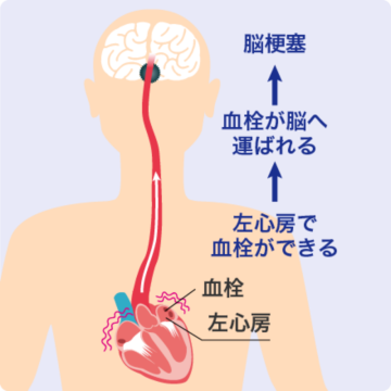 不整脈・心房細動とは？ | ジョンソン・エンド・ジョンソン
